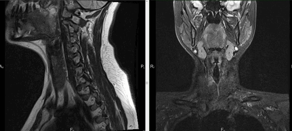 Мягкие ткани шеи на МРТ