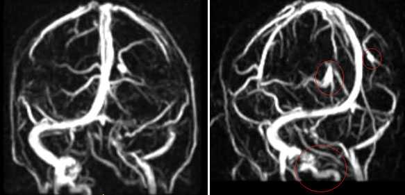 Применение МРТ в исследовании вен головного мозга