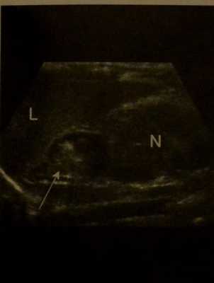 Снимки МРТ и КТ. Кровоизлияние в надпочечник