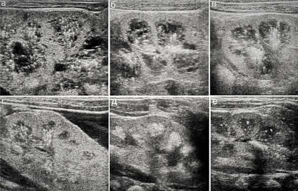 Медуллярная кистозная болезнь 4