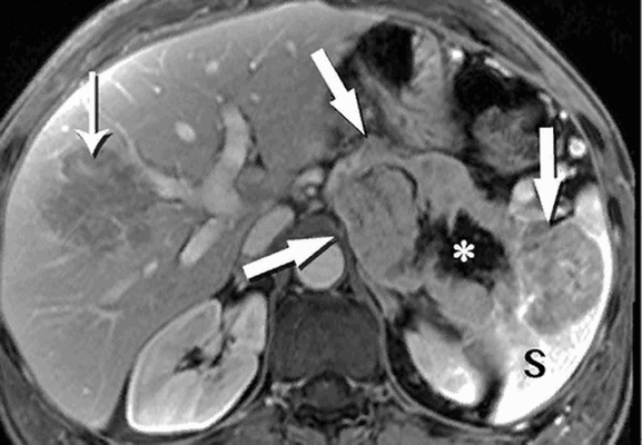 нейроэндокринная опухоль поджелудочной железы на МРТ