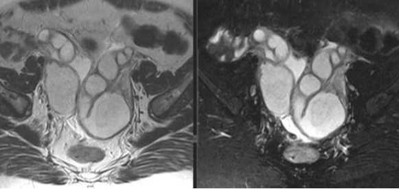 МРТ малого таза. Параовариально с обеих сторон определяются расширенные тубулярные структуры с неполными перегородками
