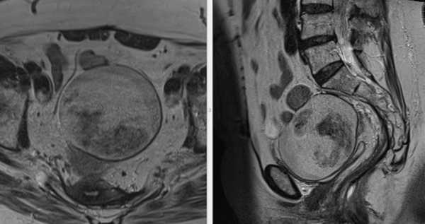 МРТ малого таза