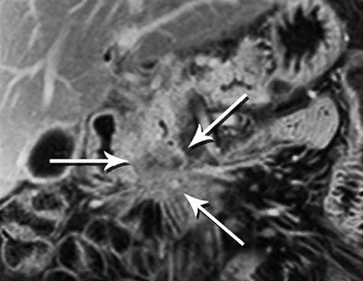Рак поджелудочной на МРТ с контрастом