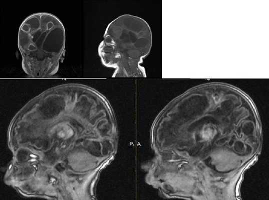 энцефаломаляция мрт