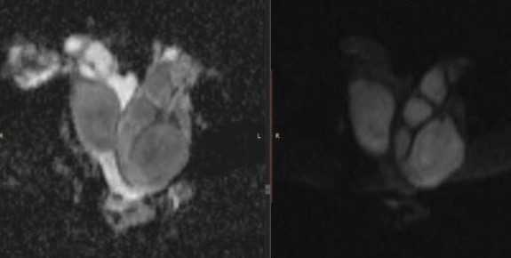 МРТ малого таза.