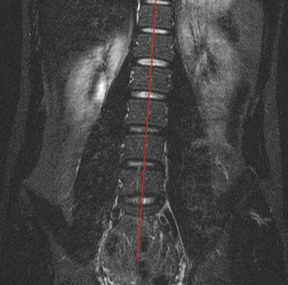 боковое искривление позвоночника на МРТ 