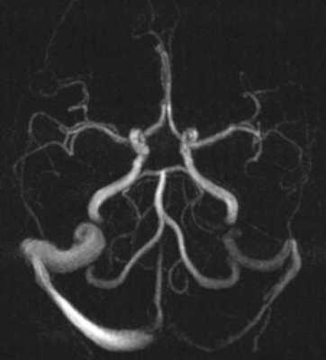 Некоторые клинические проявления внутричерепной венозной гипертензии при односторонней аплазии и гипоплазии сигмовидного и поперечного синусов твёрдой мозговой оболочки