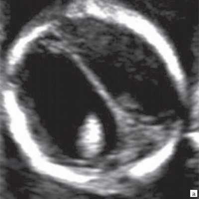 Аксиальный срез головного мозга - расширение боковых желудочков мозга при полной форме РЭС и картина серпа мозга (наблюдение 1)