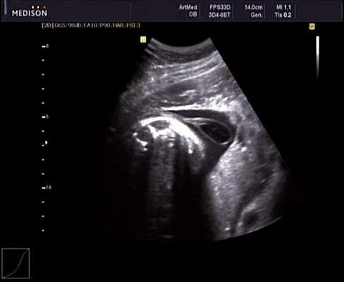 Эхограмма - эхогенность ликвора ниже эхогенности околоплодных вод, беременность 30 недель