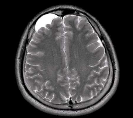 Арахноидальная киста левой височной доли