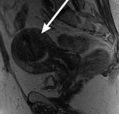 Подслизистая миома матки (указана стрелкой)