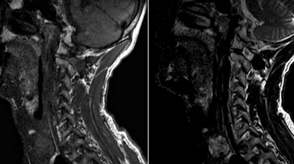 Опухоль щитовидной железы на МРТ