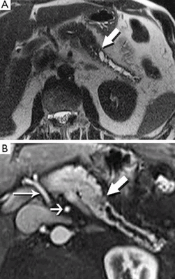 МРТ поджелудочной железы