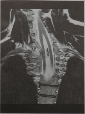 Снимки МРТ и КТ. Диастематомиелия (удвоение спинного мозга)