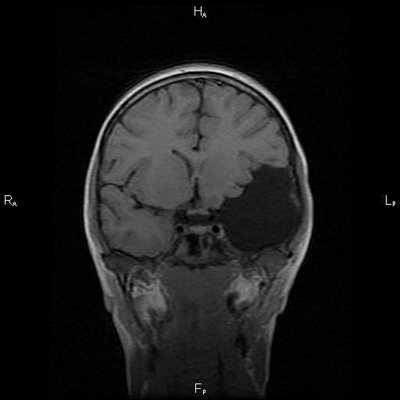 Выявление арахноидальной кисты левой височной области