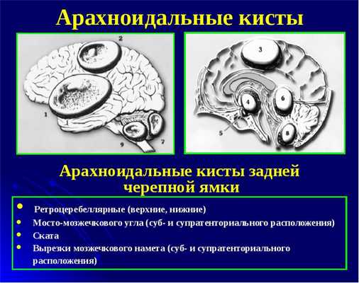 Арахноидальная киста головного мозга угрозы