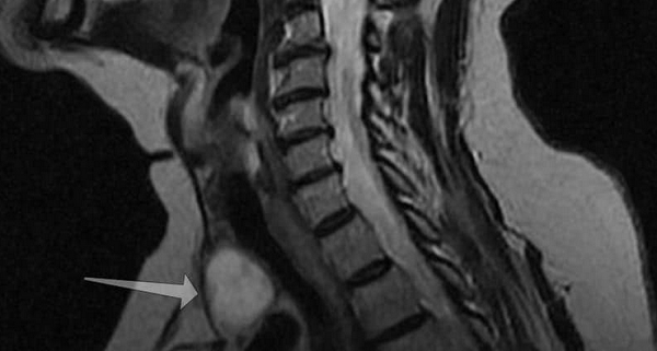Новообразование на МРТ щитовидной железы