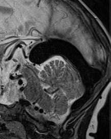 аневризма вены Галена