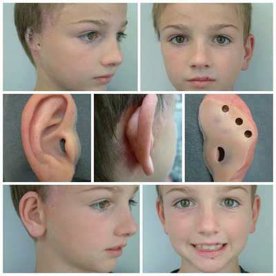 Протезирование ушной раковины