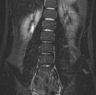 Правостороннее искривление позвоночника на МРТ
