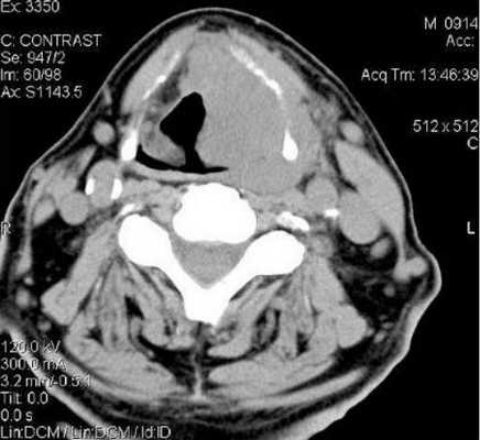 Опухоль щитовидной железы на компьютерной томографии