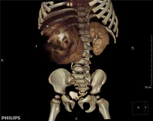 3D-реконструкции опухоли Вильмса