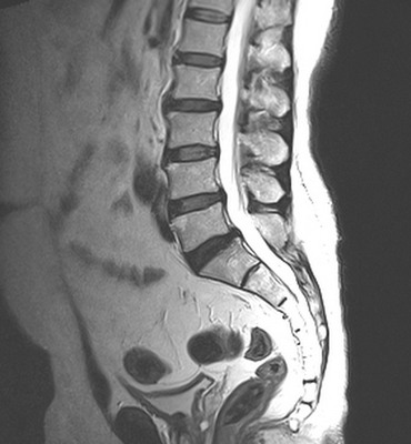 Сагиттальный срез позвоночного столба на МРТ