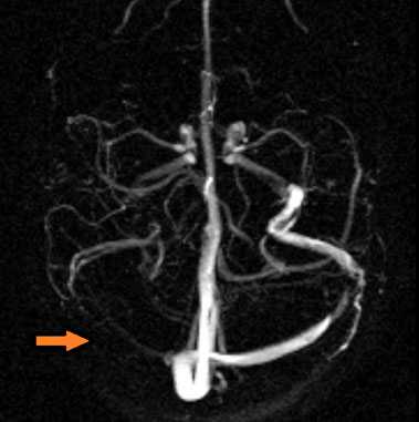 Применение МРТ в исследовании вен головного мозга