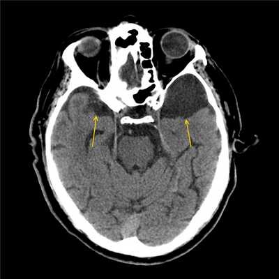 Арахноидальная киста головного мозга