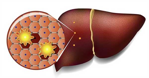 Жировой гепатоз (стеатоз печени) - мировая эпидемия