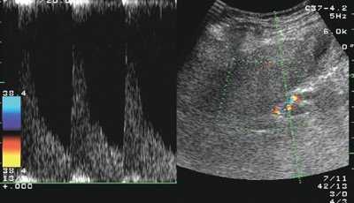 Кровоток в печеночной артерии у больного циррозом печени с неактивным алкогольным гепатитом
