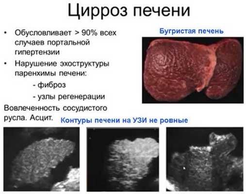 Цирроз печени на УЗИ