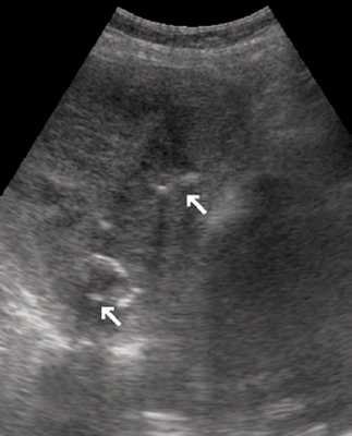 Эхограмма (B-режим) - гигантская кавернозная гемангиома печени с кальцинатами внутри (стрелки)