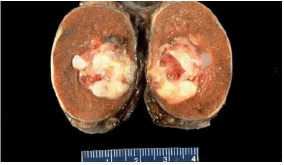 Герминогенная опухоль яичка (макропрепарат)