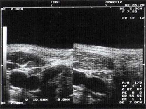 Эхографическое изображение непальпируемого югулярного лимфатического узла на фоне остаточных явлений после перенесенного фарингита