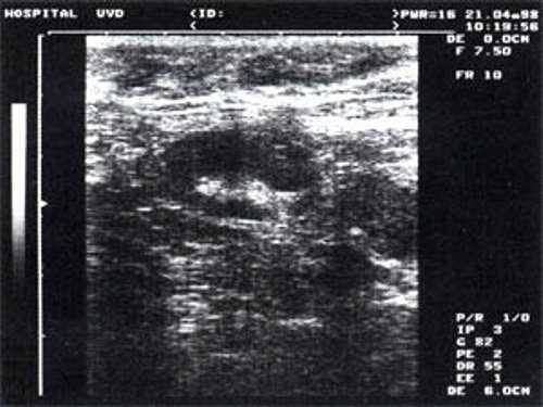 УЗ-томограмма увеличенного реактивно измененного лимфатического узла на фоне аденовирусной инфекции до лечения