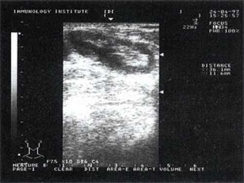 Изображение увеличенного лимфатического узла с УЗ-признаками доброкачественной аденопатии у больного с синдромом иммунодефицита (а)