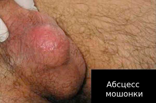 Абсцесс мошонки