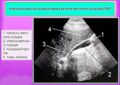 Нормальная УЗи картина желчного пузыря
