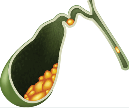 Выявление сладжа и холецистита на УЗИ желчного пузыря