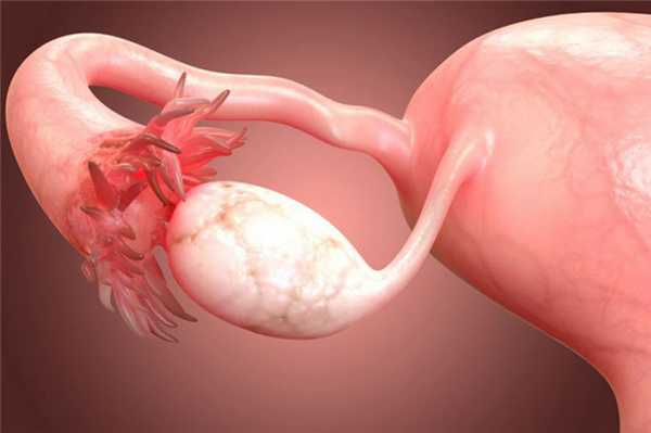 Киста яичника — симптомы, виды, лечение