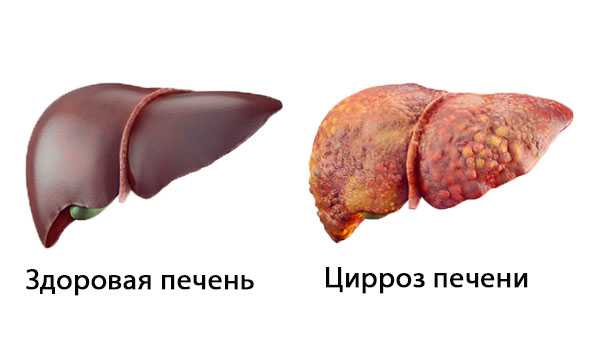 Цирроз печени