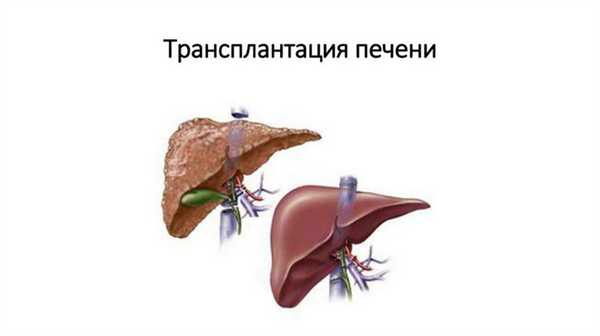Трансплантация печени