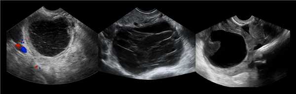 На УЗИ киста с геморрагическим содержимым видна как округлая полость с гиперэхогенными включениями