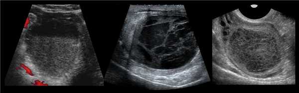 При допплерометрии геморрагическое образование желтого тела имеет «огненный ободок»