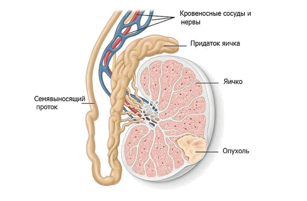 Опухоль в яичке