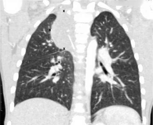 КТ органов грудной клетки - семинома средостения.