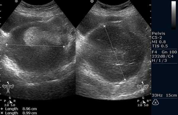 Тератома яичника (УЗИ малого таза)