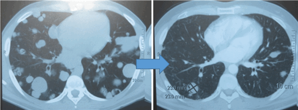 Метастазы в легких до лечения и после 4х циклов химиотерапии по схеме «ВЕР» (КТ грудной клетки)
